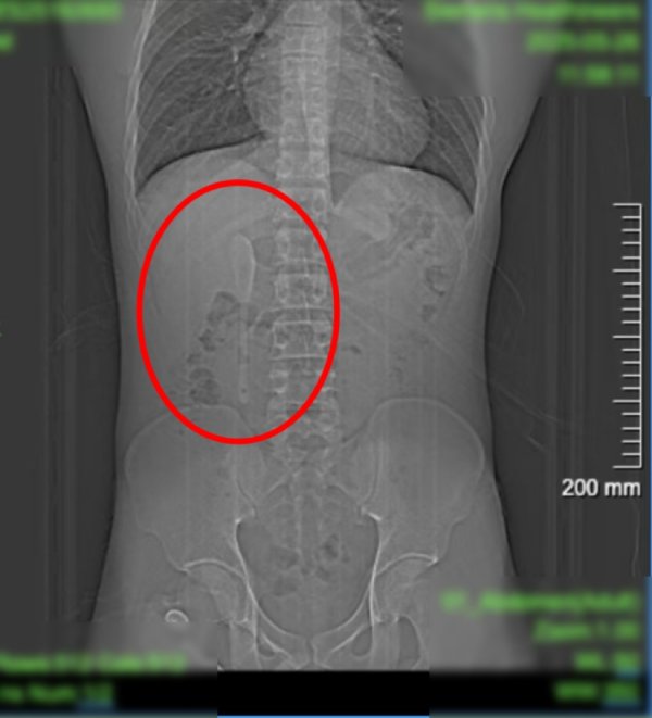 元富证券 醉酒催吐，15厘米咖啡勺滑入肠道还当做梦；中山医院内镜中心“双钳”取勺